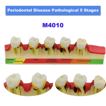 Модель зубов, модель обучения стоматологии, Патологические заболевания пародонта, 5 этапов прогресса, общение с пациентами Стоматолога